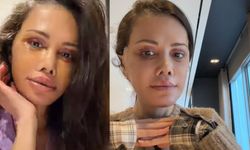 Eski Survivor yarışmacısı Didem Ceran  yüz nakli yaptırdı! Son hali şoke etti!