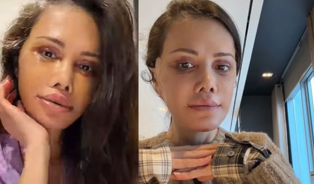 Eski Survivor yarışmacısı Didem Ceran  yüz nakli yaptırdı! Son hali şoke etti!