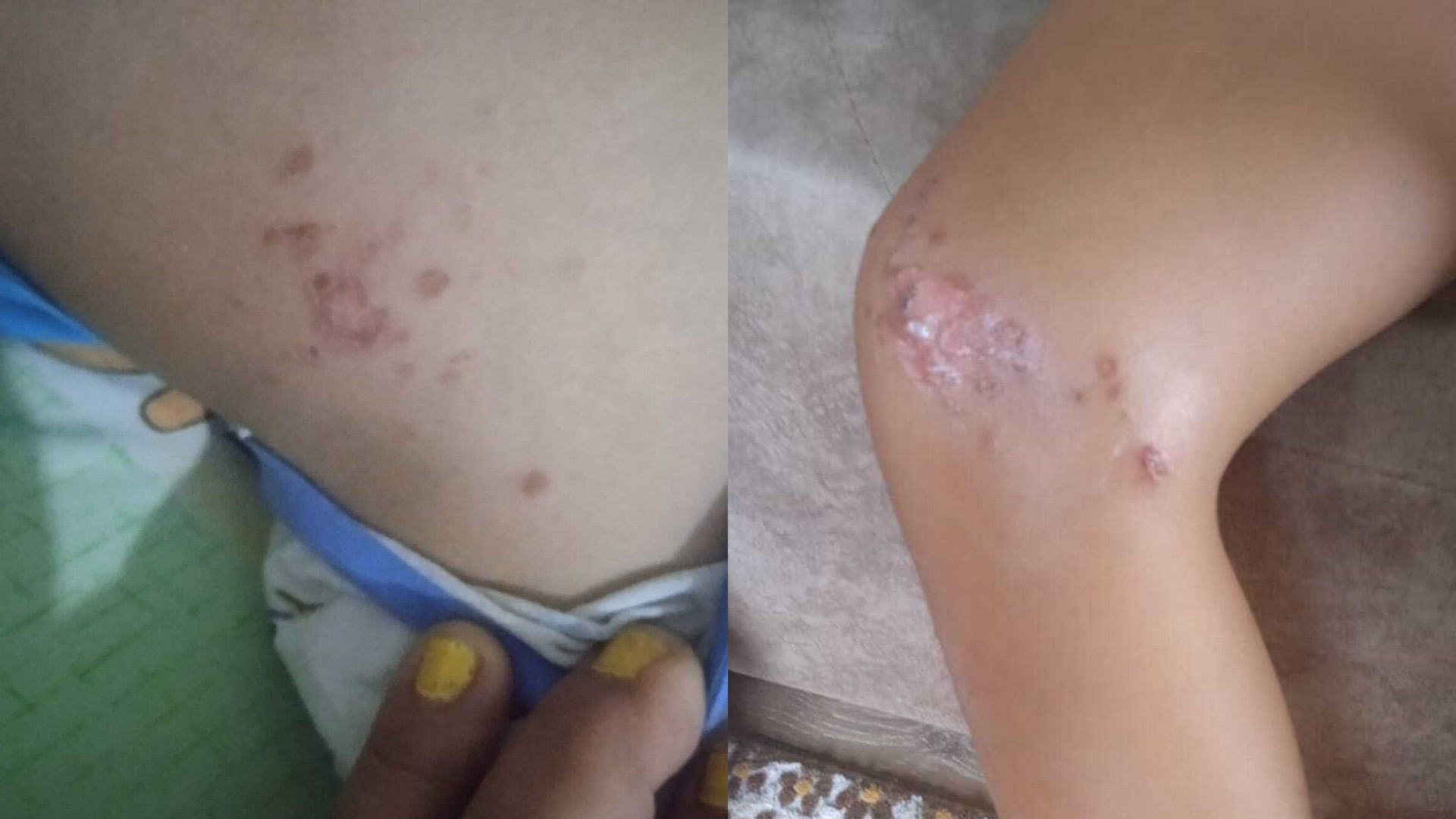 Sahildelenfeksiyoniddiasiekiplerincelemebaslatt1