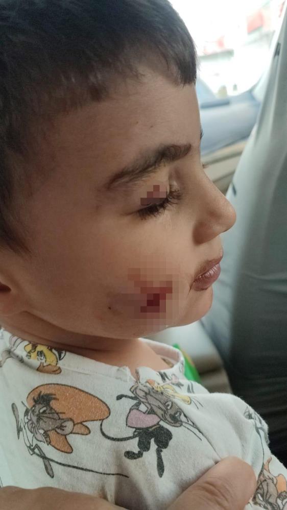 Ankaradafaretarafındanısırılancocugakuduzasısıveantibiyotikyapıldı